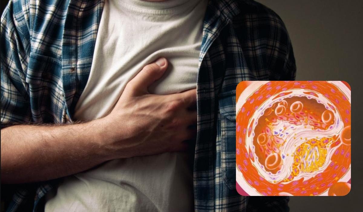 Mengapa Kolesterol Tinggi Bisa Membahayakan Kesehatan Jangka Panjang